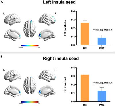 Altered resting-state functional connectivity of insula in children with primary nocturnal enuresis